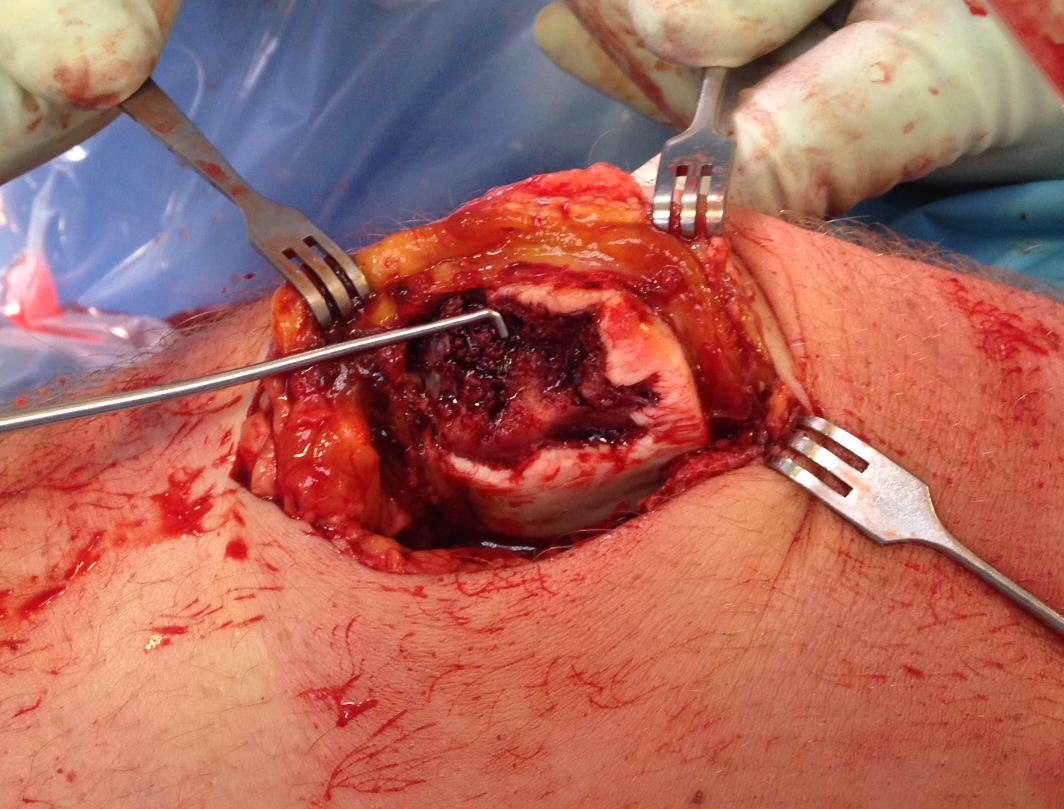 Patella Ostechondral Fracture